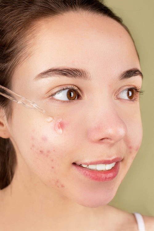 Acne & rosacea