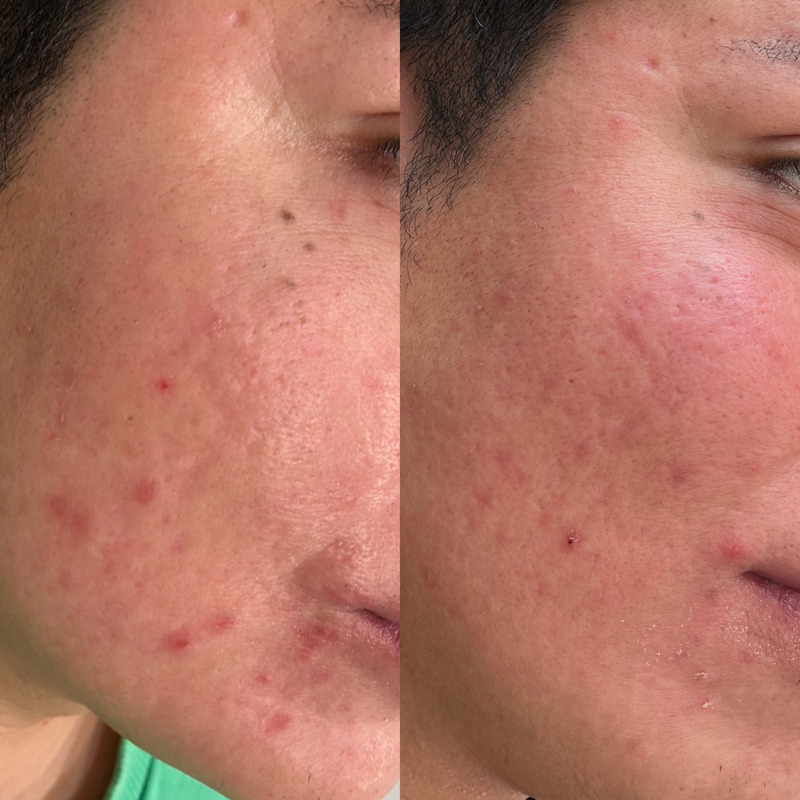 Wat zijn polynucleotiden? De wetenschap achter de ‘salmon sperm facial’ trend
