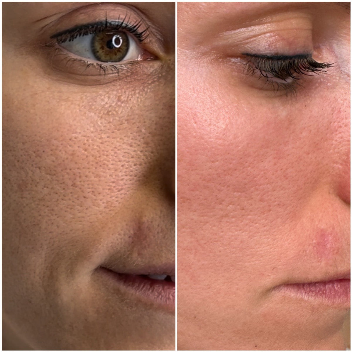 deepclean voor en na detail huid