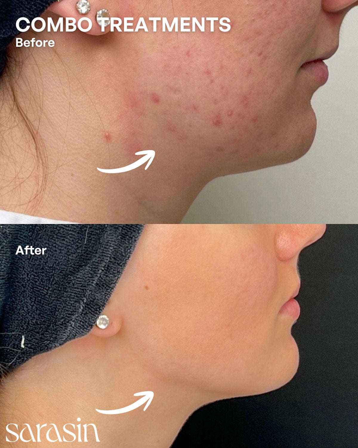 combo treatments: skincare, hifu, reyu