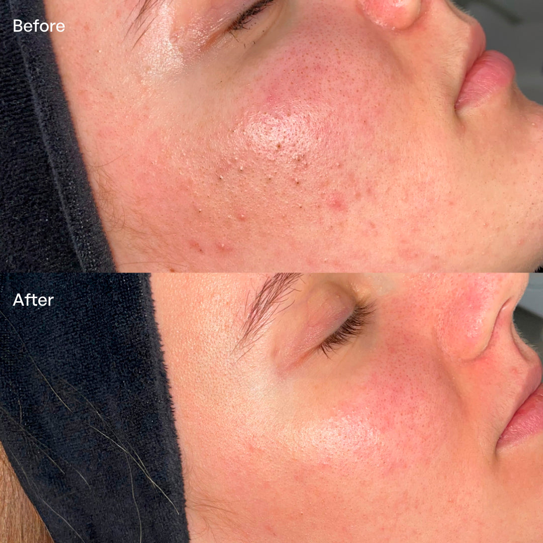 acne resultaat sarasin clinic tara