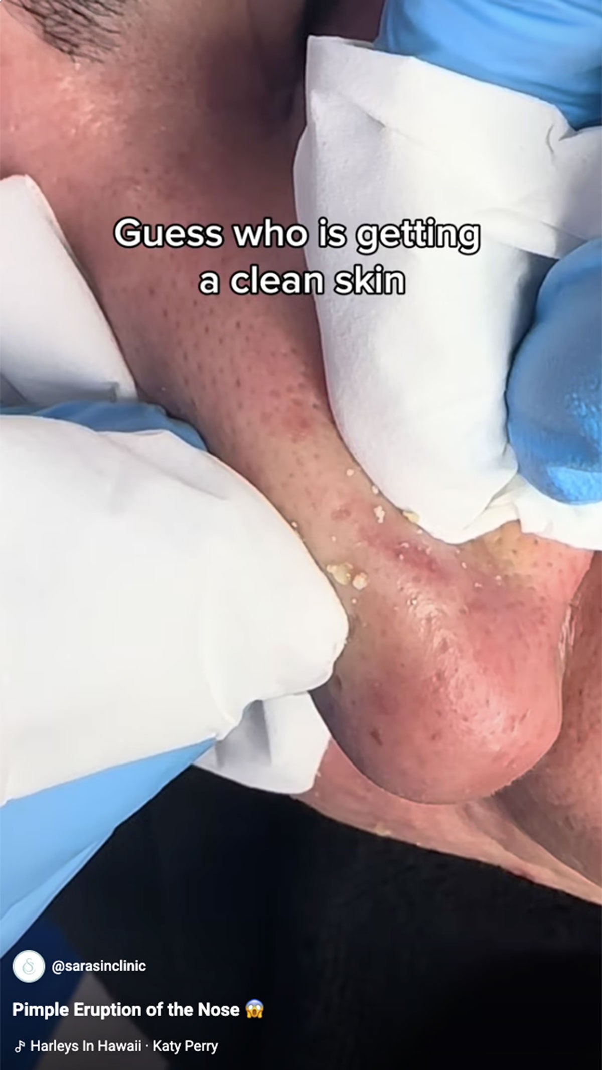 video mee eters verwijderen