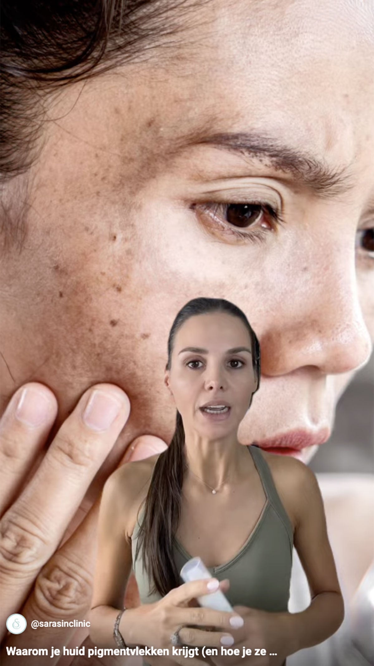 video Waarom je huid pigmentvlekken krijgt