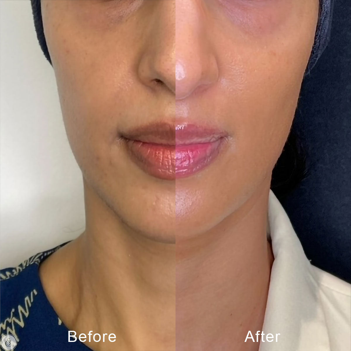 collageen voor en na resultaat