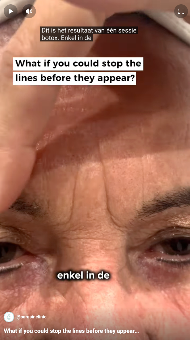 sarasin video botox frons