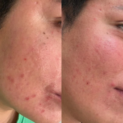 Wat zijn polynucleotiden? De wetenschap achter de ‘salmon sperm facial’ trend